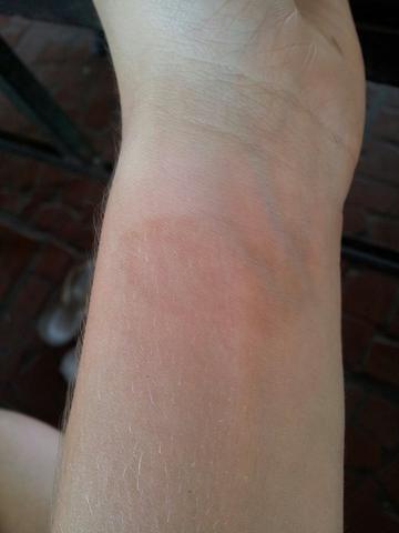 Dermatologen Plotzlich Braune Grosse Flecken Auf Dem Arm Arzt Dermatologie Leberfleck