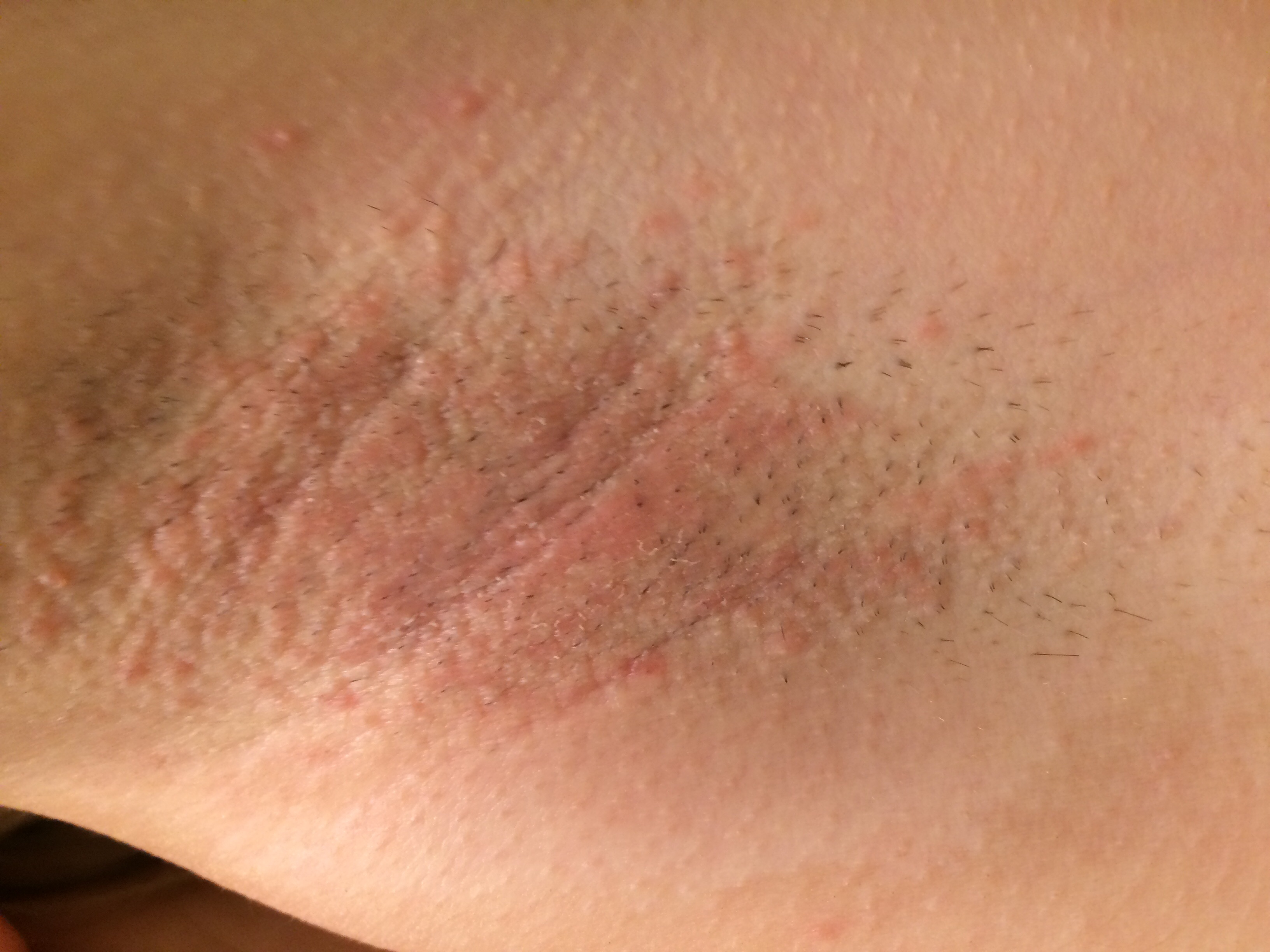 Deshalb Zum Arzt Bild Im Anhang Entzundung Achsel Deshalb Zum Arzt Bild Im Anhang Entzundung Achsel