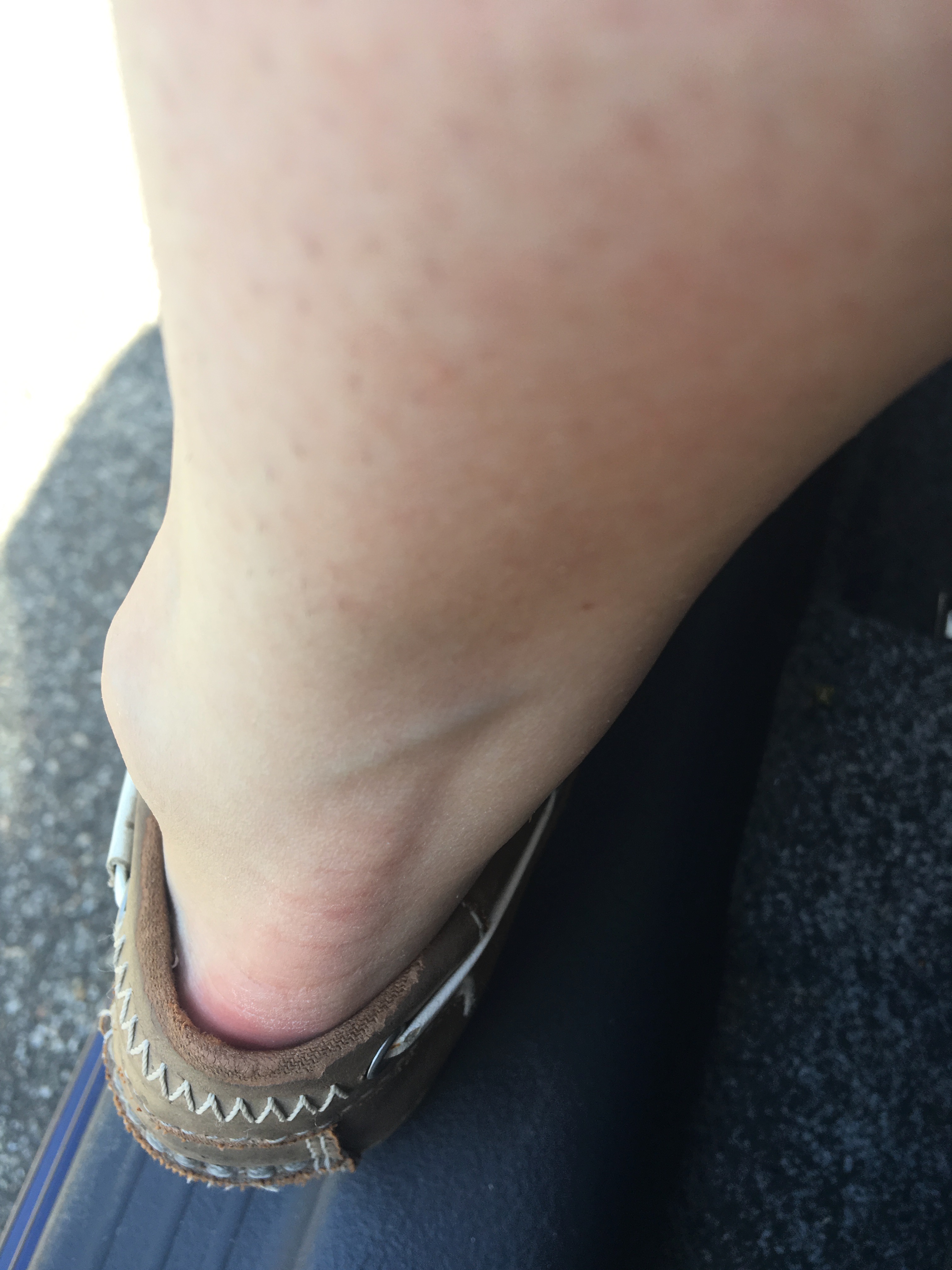 Dicke Ader Thrombose Gesundheit Und Medizin Venen Dicke Ader Thrombose Gesundheit Und Medizin Venen