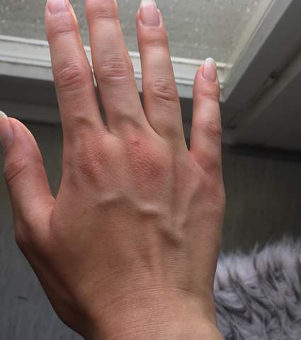 Dicke Adern An Den Handen Gesundheit Und Medizin Korper Hand Dicke Adern An Den Handen Gesundheit Und Medizin Korper Hand