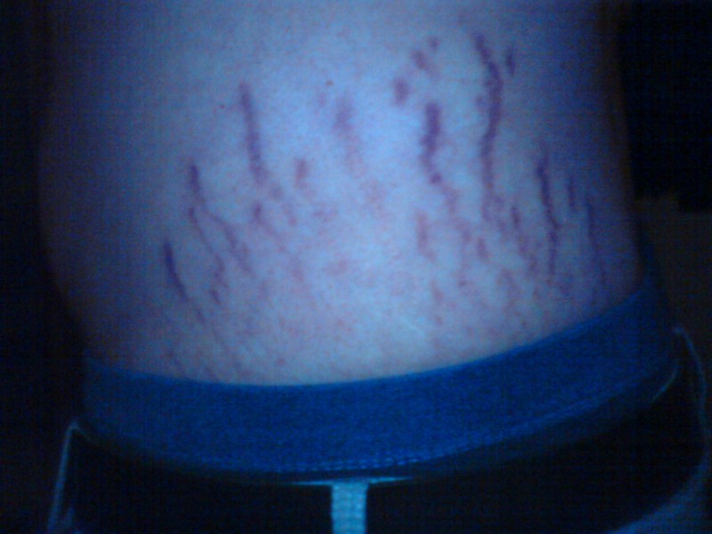 Rote Streifen Am Bauch Krankheit www.gutefrage.net