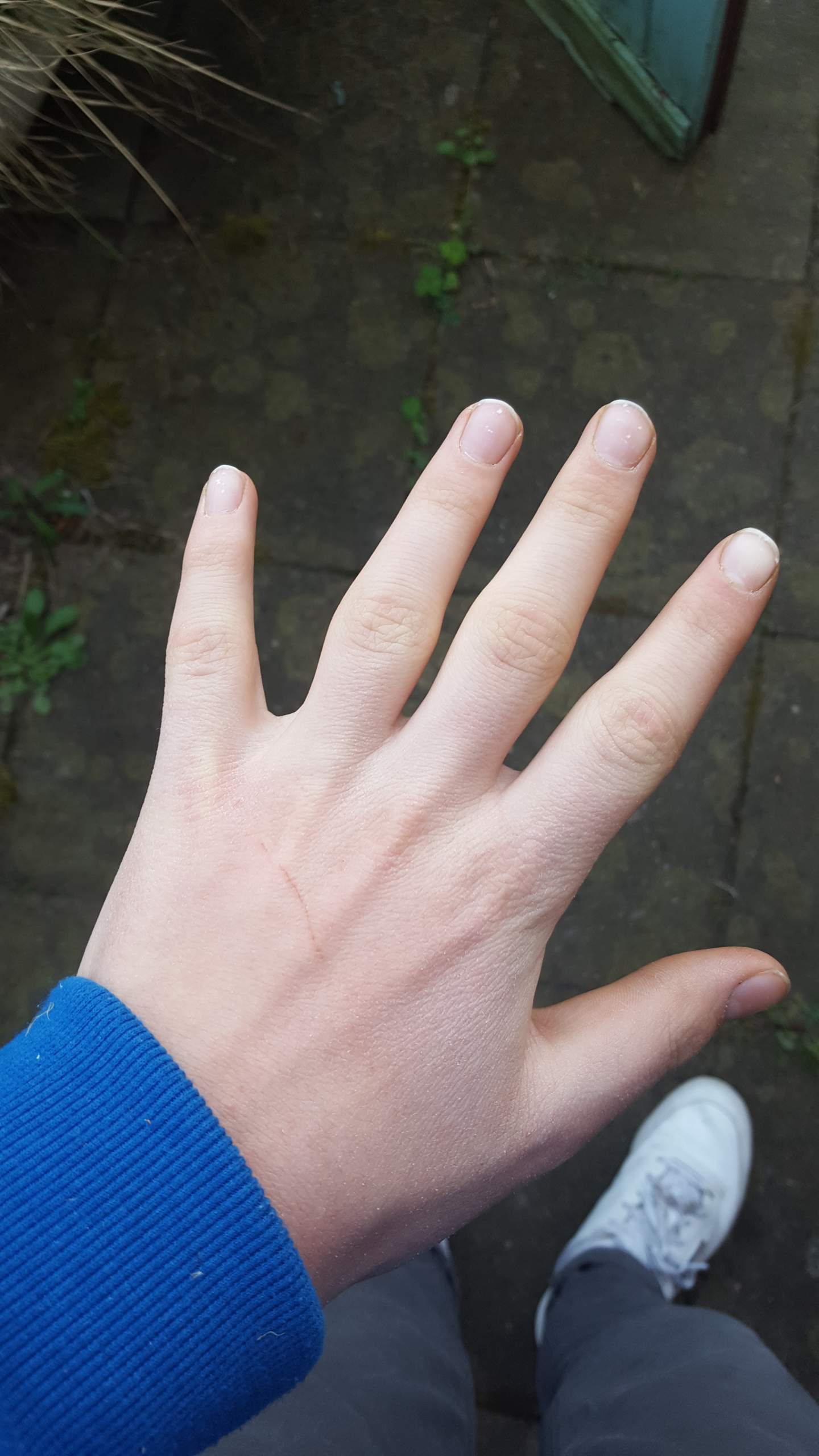 Dicke Fingermittelgelenke? (Gesundheit, Knochen, Finger)