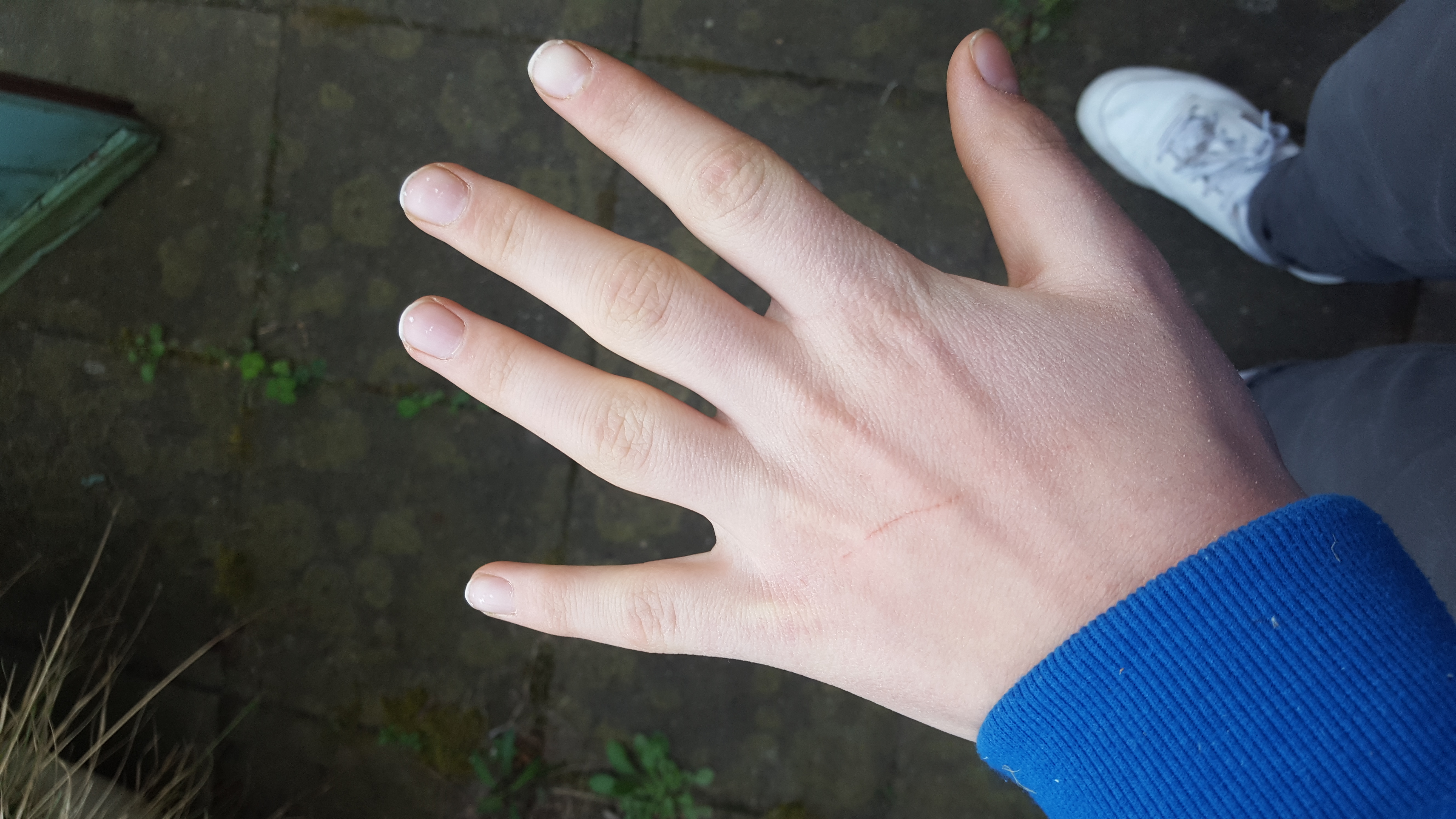 Dicke Fingermittelgelenke? (Gesundheit, Finger, Knochen)