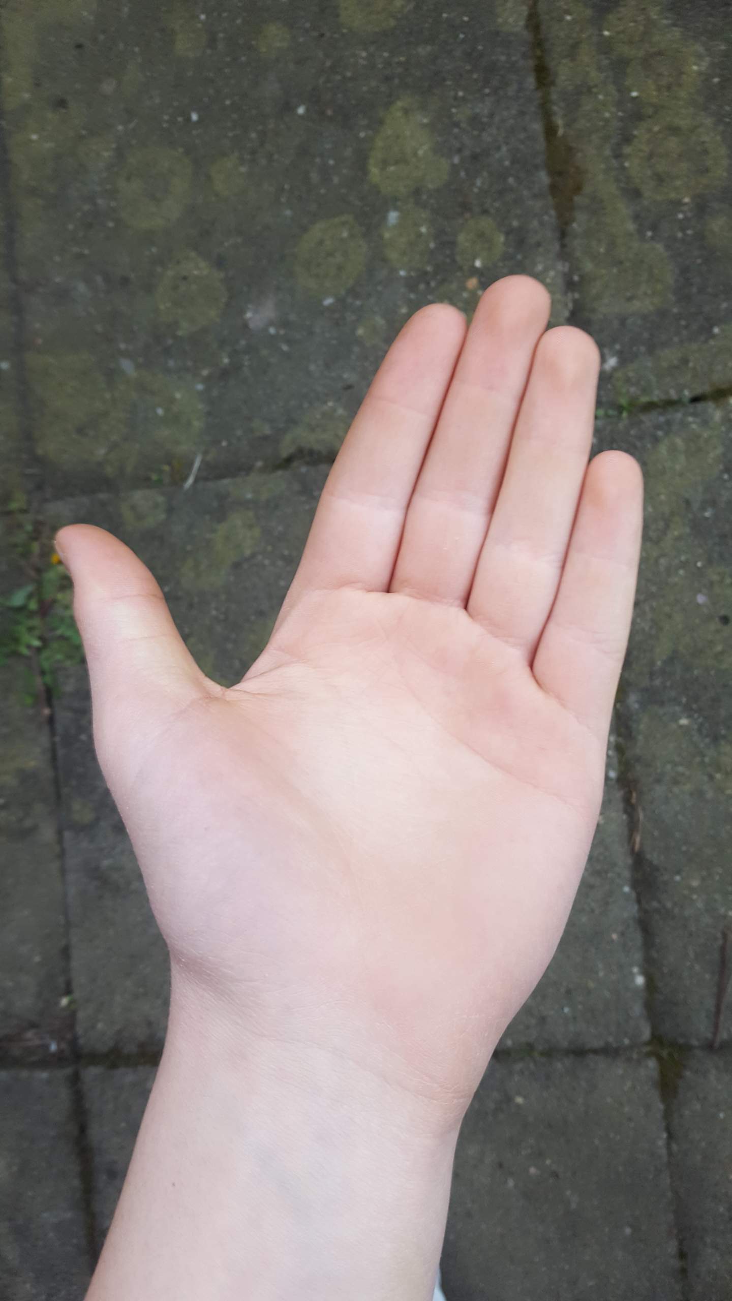 Dicke Fingermittelgelenke? (Gesundheit, Knochen, Finger)