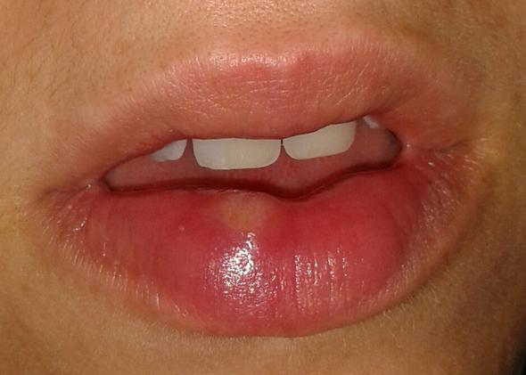 Dicke Lippe - (Gesundheit, Lippe, Herpes)