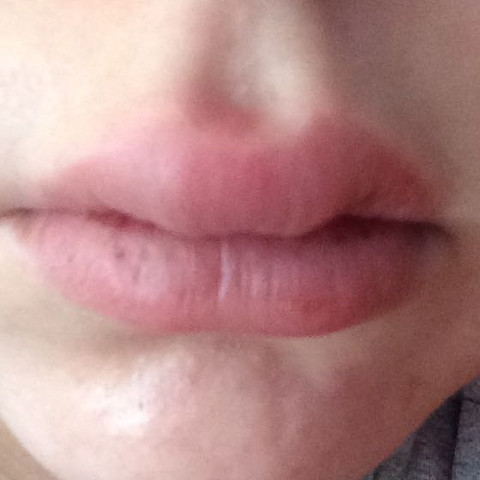 Meine Lippe  - (Pickel, Lippe, angeschwollen)