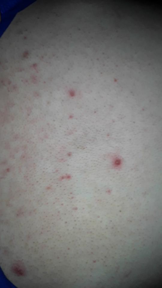 Dicke Pickel Auf Der Brust Gesundheit Und Medizin Haut Dicke Pickel Auf Der Brust Gesundheit Und Medizin Haut