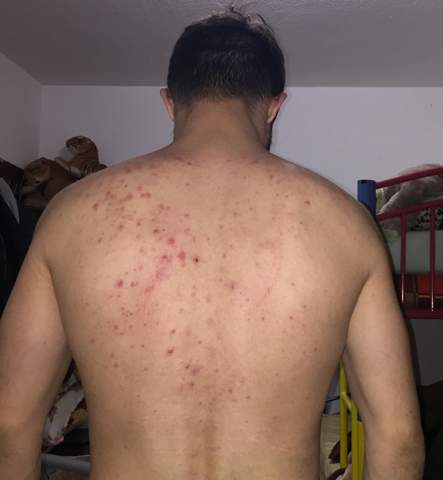 Dicke Pickel Viele Am Rucken Und Am Hals Sowie Auch Gesicht Hilfe Selbst Der Arzt Bringt Nichts Gesundheit Und Medizin Haut Hautpflege Dicke Pickel Viele Am Rucken Und Am Hals Sowie Auch Gesicht Hilfe Selbst Der Arzt Bringt Nichts Gesundheit Und Medizin Haut Hautpflege