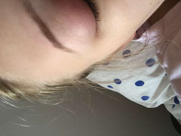 Dicke Schwellung Am Auge Augen Dicke Schwellung Am Auge Augen