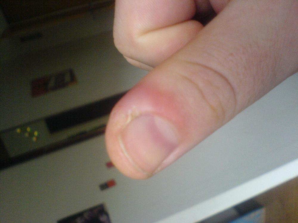 dicker Daumen schmerzt (Gesundheit, Medizin)
