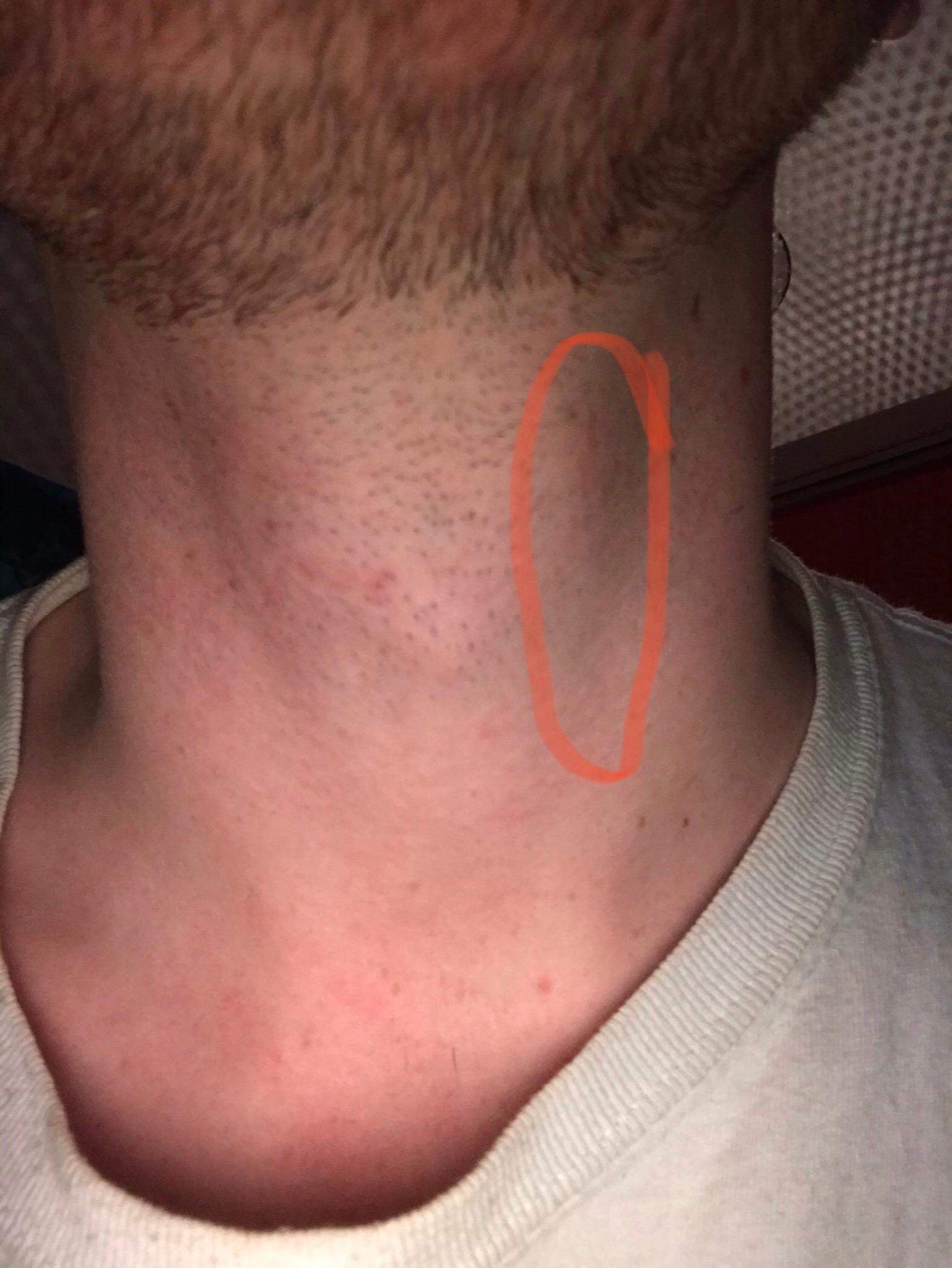 Dicker Knubbel rechts am Hals? (Gesundheit und Medizin, Gesundheit, Medizin)