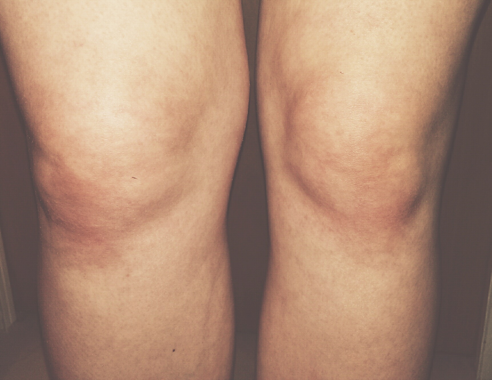 Dickes Knie Schmerzen Was Kann Es Sein Geschwollen Dickes Knie Schmerzen Was Kann Es Sein Geschwollen