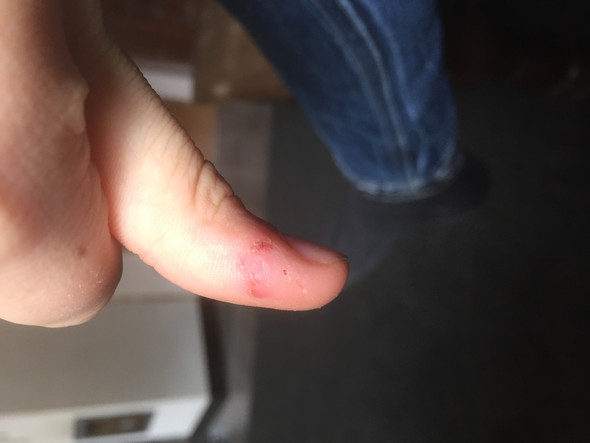 So sehen alle meine Finger aus. - (Depression, Finger)