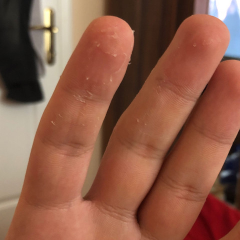 Die Haut An Meinen Fingern Komplett Schalt Sich Ab Warum Arzt Krankheit Krank Die Haut An Meinen Fingern Komplett Schalt Sich Ab Warum Arzt Krankheit Krank
