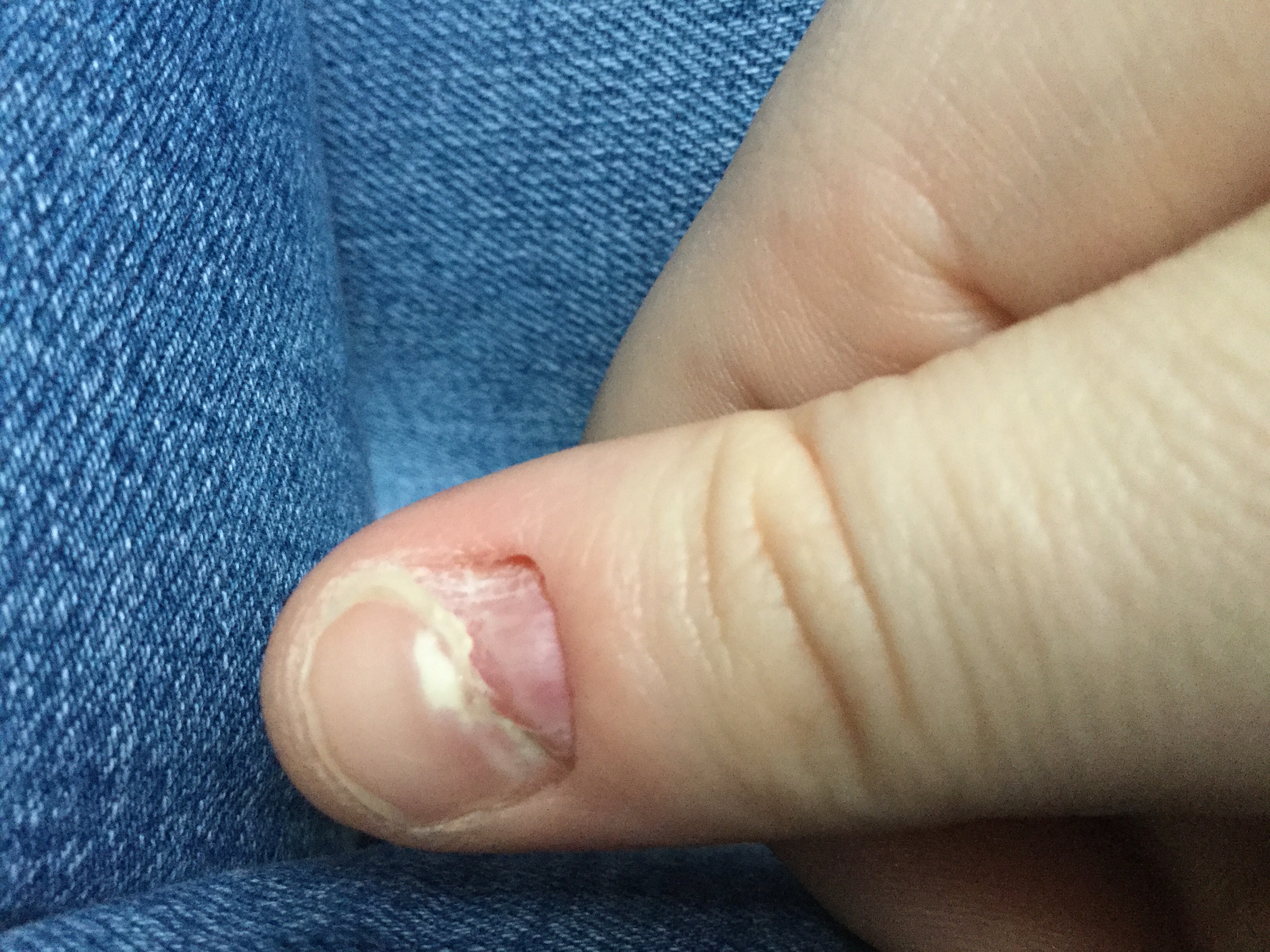 Die Haut unter meinem Nagel löst sich ab? (Nägel, Entzündung) Die Haut unter meinem Nagel löst sich ab? (Nägel, Entzündung)