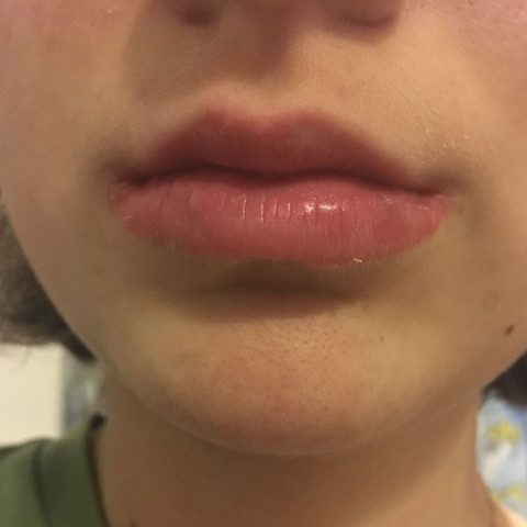 Die Lippen Meiner Kleinen Schwester Sind Entzundet Was Tun Gesundheit Und Medizin Rot Lippe