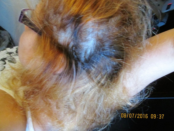 Haarausfall seitlich  - (Haarausfall, Vitamine)