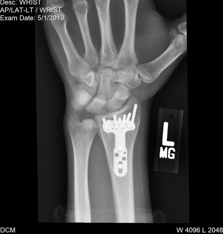 Distale Radius Fraktur Platte Schrauben Rontgenbild Gesundheit Und Medizin Gesundheit Operation Distale Radius Fraktur Platte Schrauben Rontgenbild Gesundheit Und Medizin Gesundheit Operation