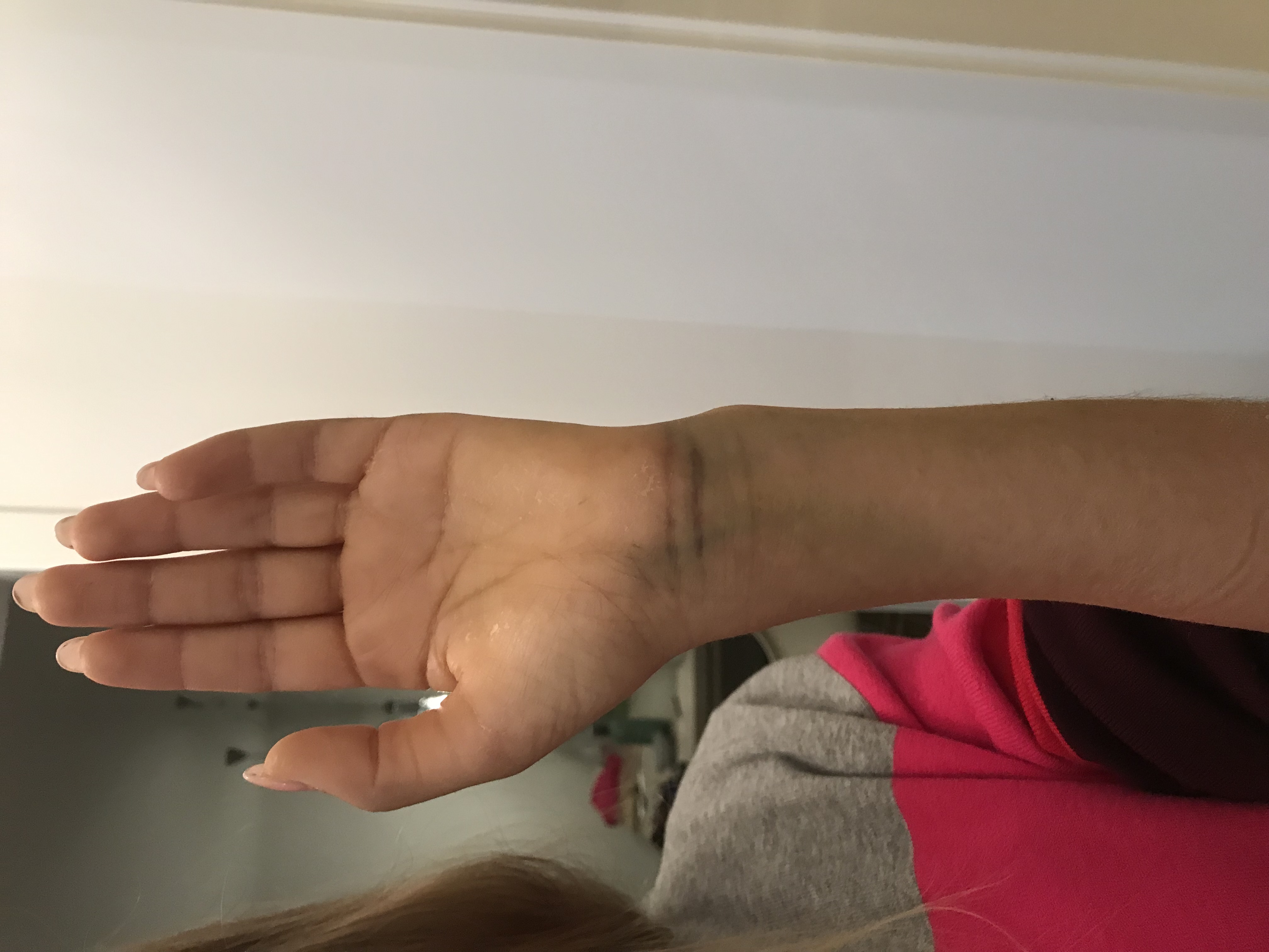 Distale Radiusfraktur Blauer Fleck Und Fehlstellung Normal Nach 5 Wochen Gesundheit Und Medizin Medizin Arzt Distale Radiusfraktur Blauer Fleck Und Fehlstellung Normal Nach 5 Wochen Gesundheit Und Medizin Medizin Arzt