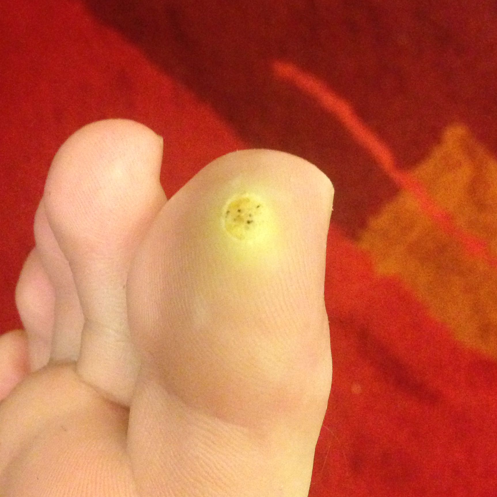 Dornwarze entfernen mit Tinktur? (Behandlung, Warzen)