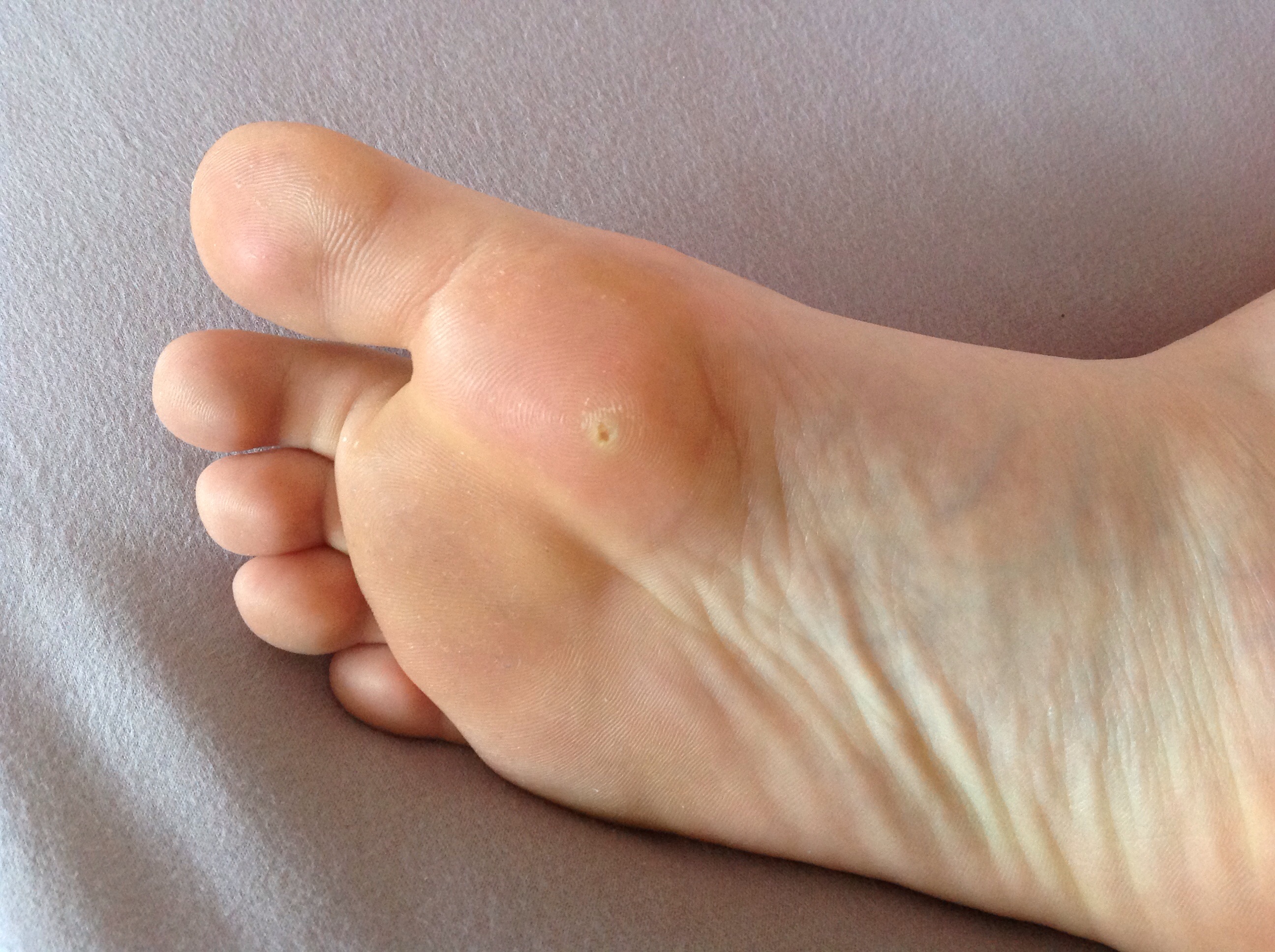 Dornwarze Hornhaut Was Ist Das Medizin Fusse Warzen Dornwarze Hornhaut Was Ist Das Medizin Fusse Warzen