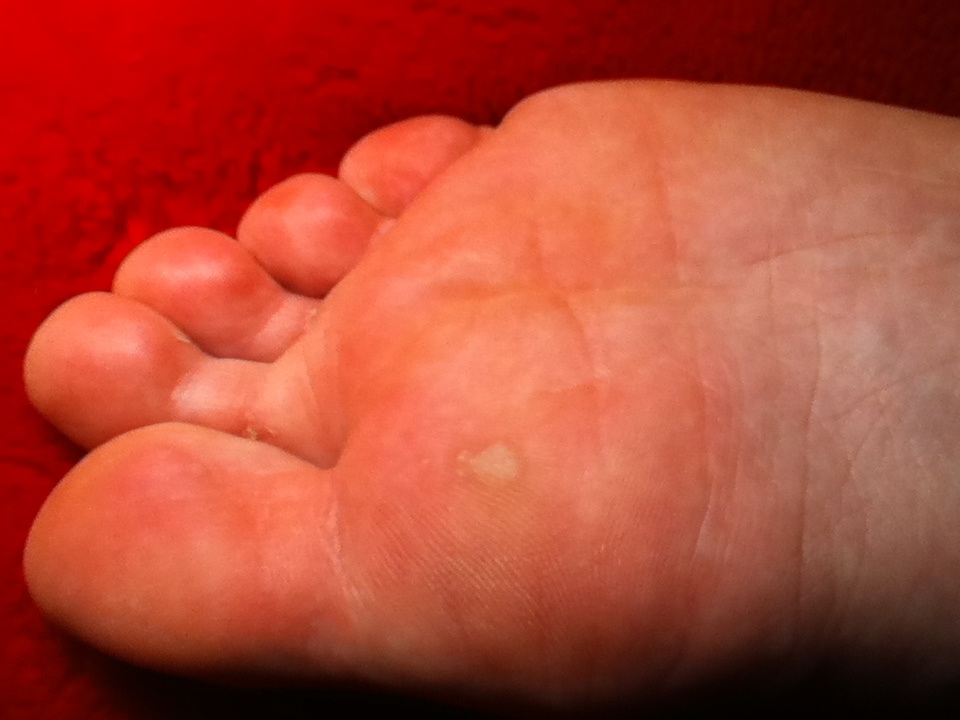 Dornwarze oder Hühnerauge unter dem Fuß? Arzt? (Gesundheit, Gesundheit Dornwarze oder Hühnerauge unter dem Fuß? Arzt? (Gesundheit, Gesundheit