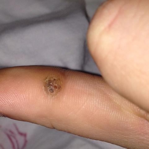 Wird schwarz weh tut warze und Wie können