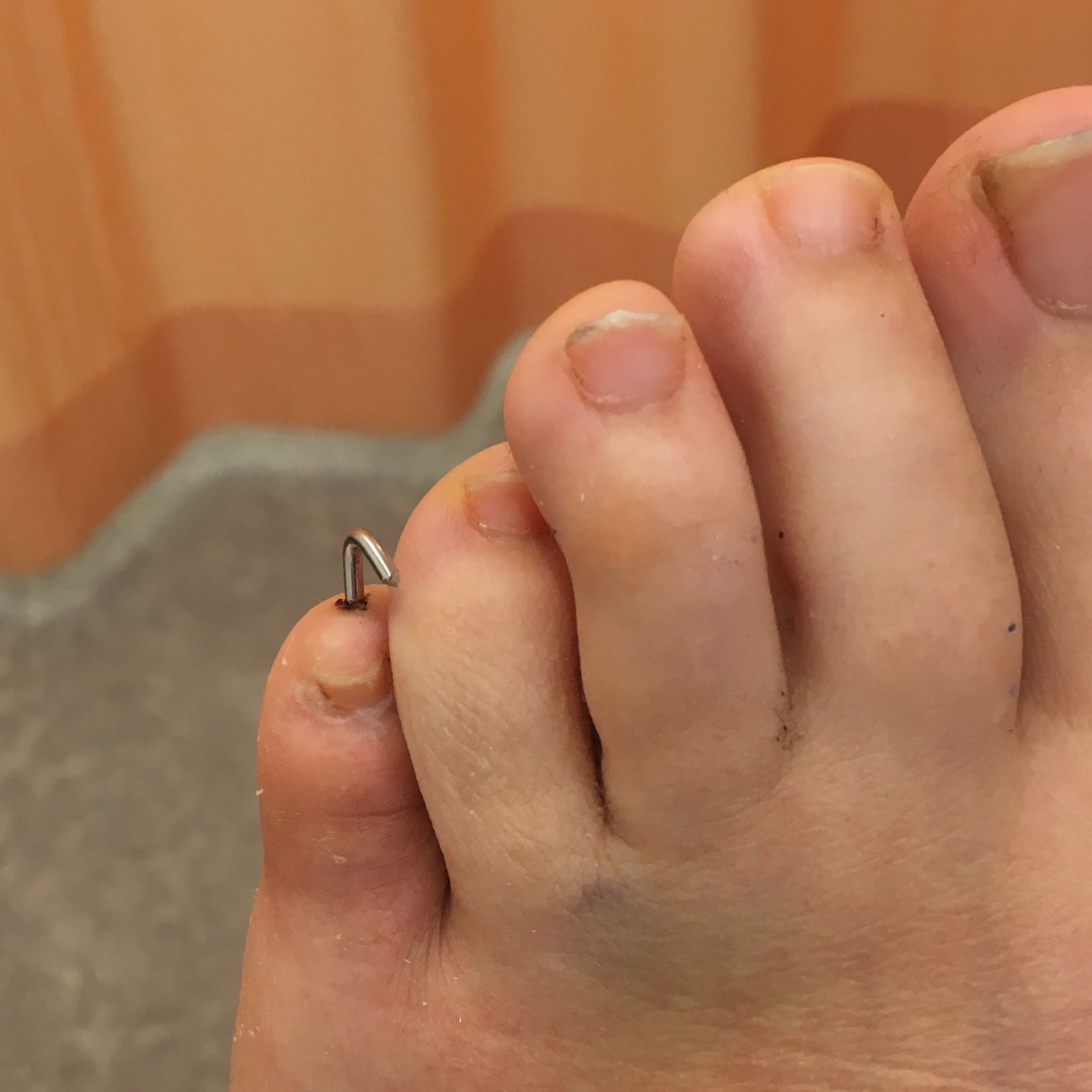 Draht Entfernen Kleiner Zeh Schmerzen Gesundheit Und Medizin Entfernung Draht Entfernen Kleiner Zeh Schmerzen Gesundheit Und Medizin Entfernung