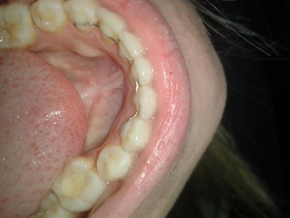 Draht hinter den Unterzähnen - (Zähne, Zahnarzt, Zahnspange)