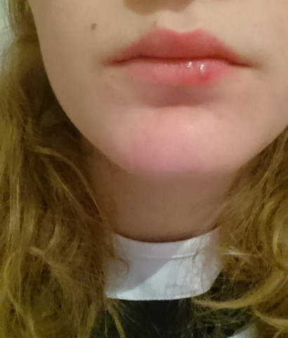 Dringend Bin Verzweifelt Herpes Was Tun Lippe Lippenherpes