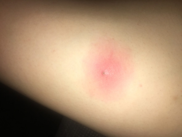 Dringende Hilfe Bei Insektenstich Gesundheit Und Medizin Schmerzen Dringende Hilfe Bei Insektenstich Gesundheit Und Medizin Schmerzen