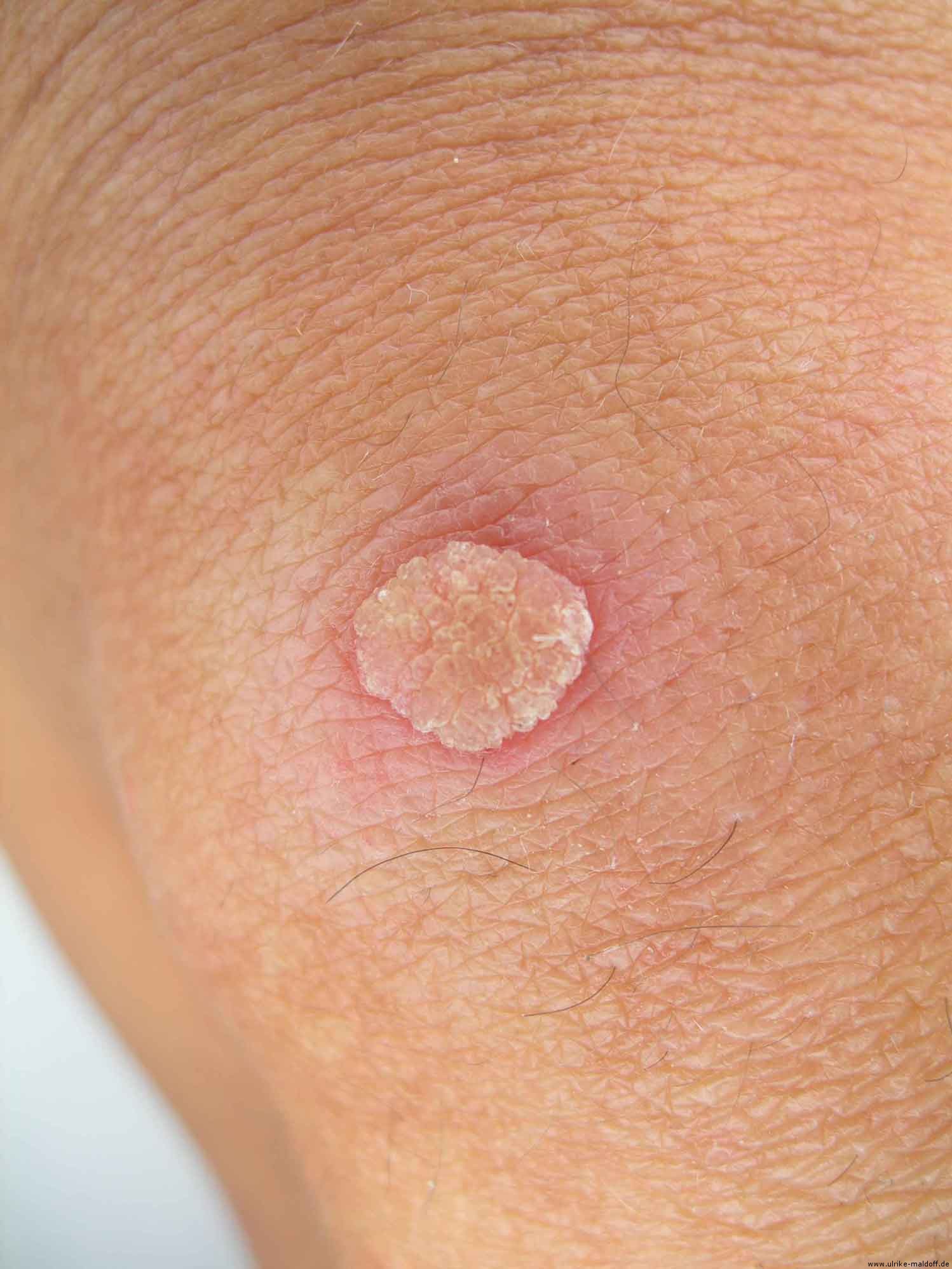 Dringende Hilfe!Warzee. . . (Warzen) Dringende Hilfe!Warzee. . . (Warzen)