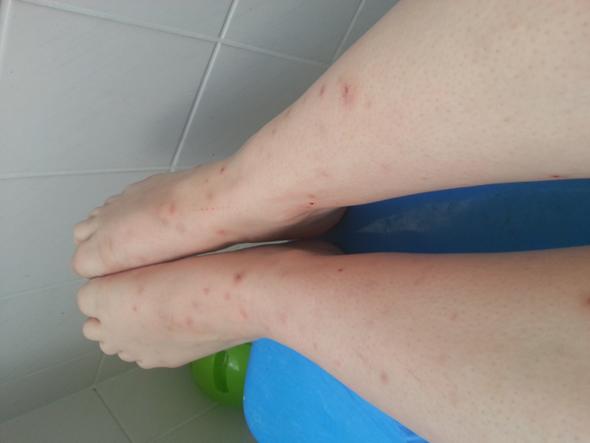 Flohbisse an meinen Beinen - (Menschen, Katze, Parasiten)