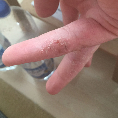 Der kleine Finger - (Krankheit, Haut, krank)