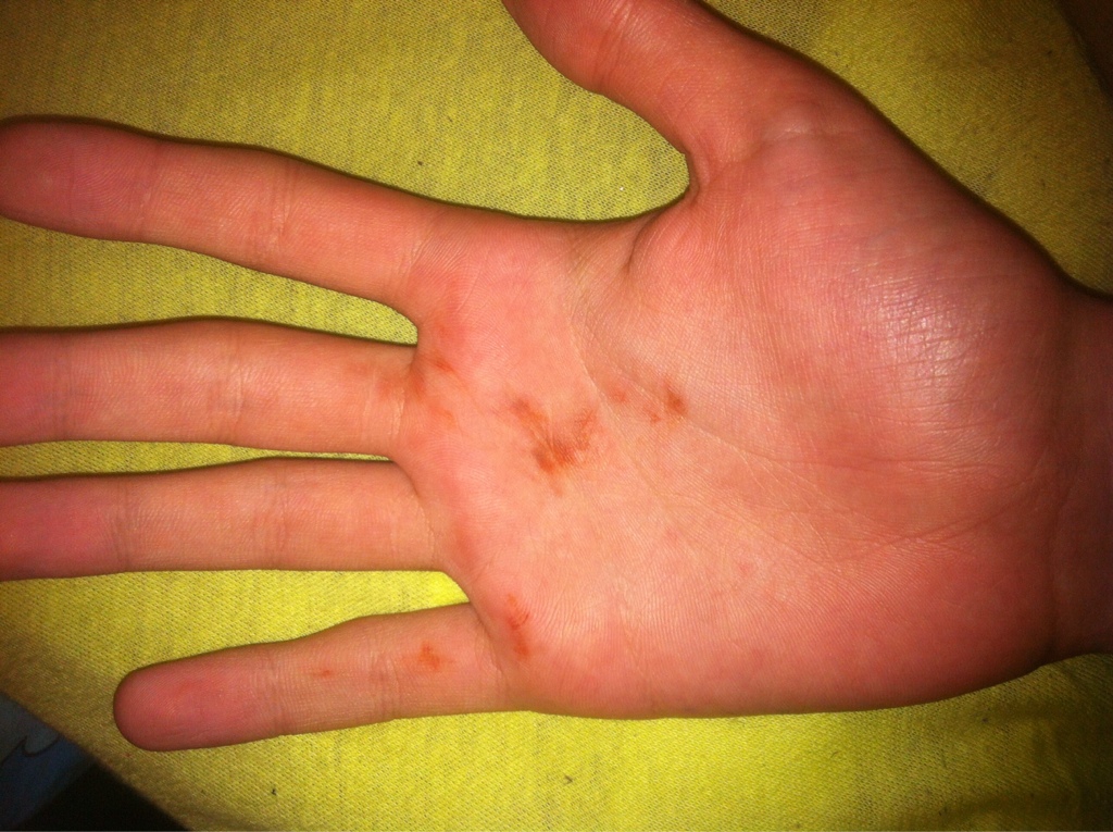 HandinnenflГ¤che Juckt Bedeutung HandinnenflГ¤che Juckt Bedeutung
