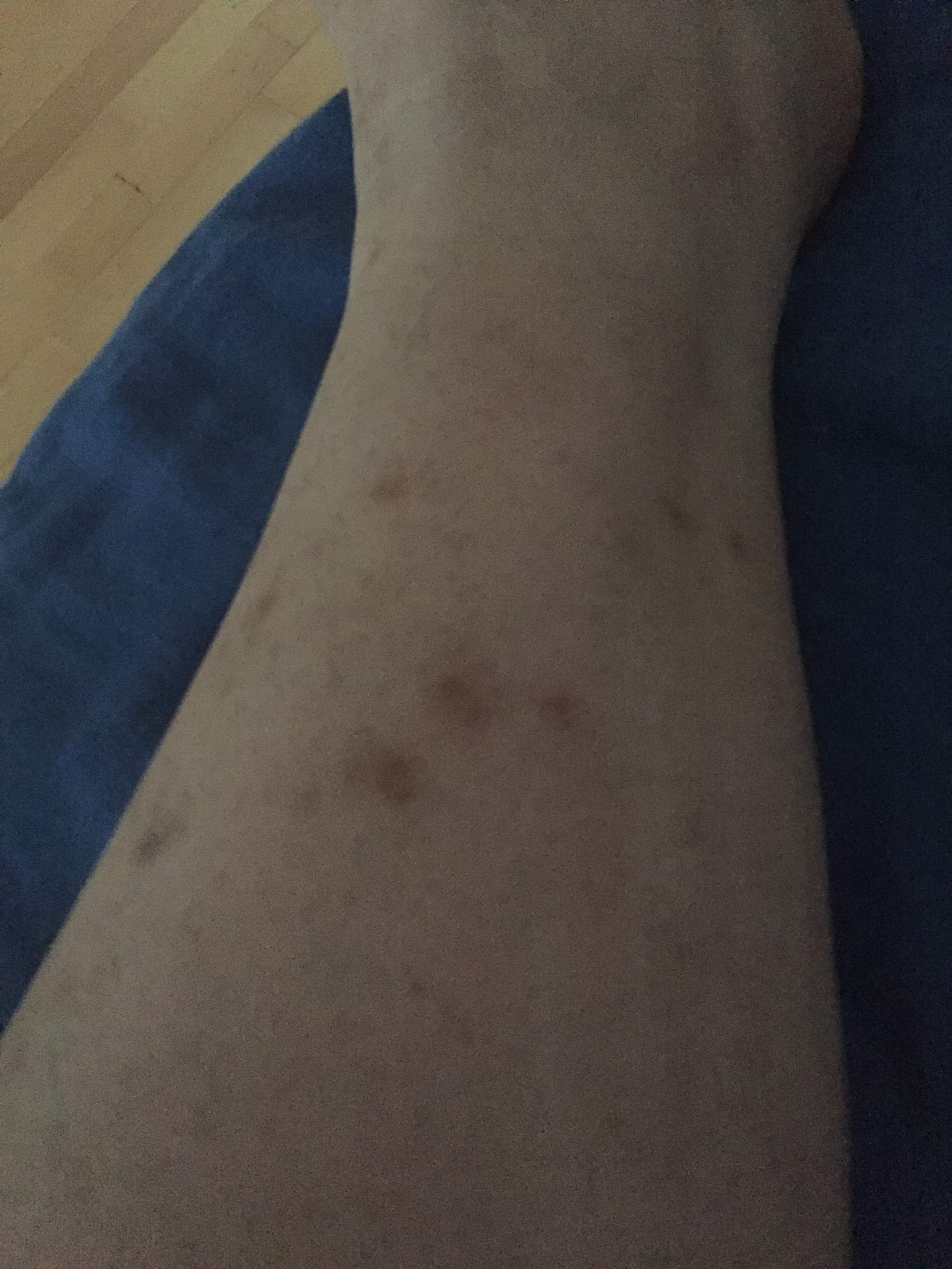 dunkle flecken nach mückenstich bilder