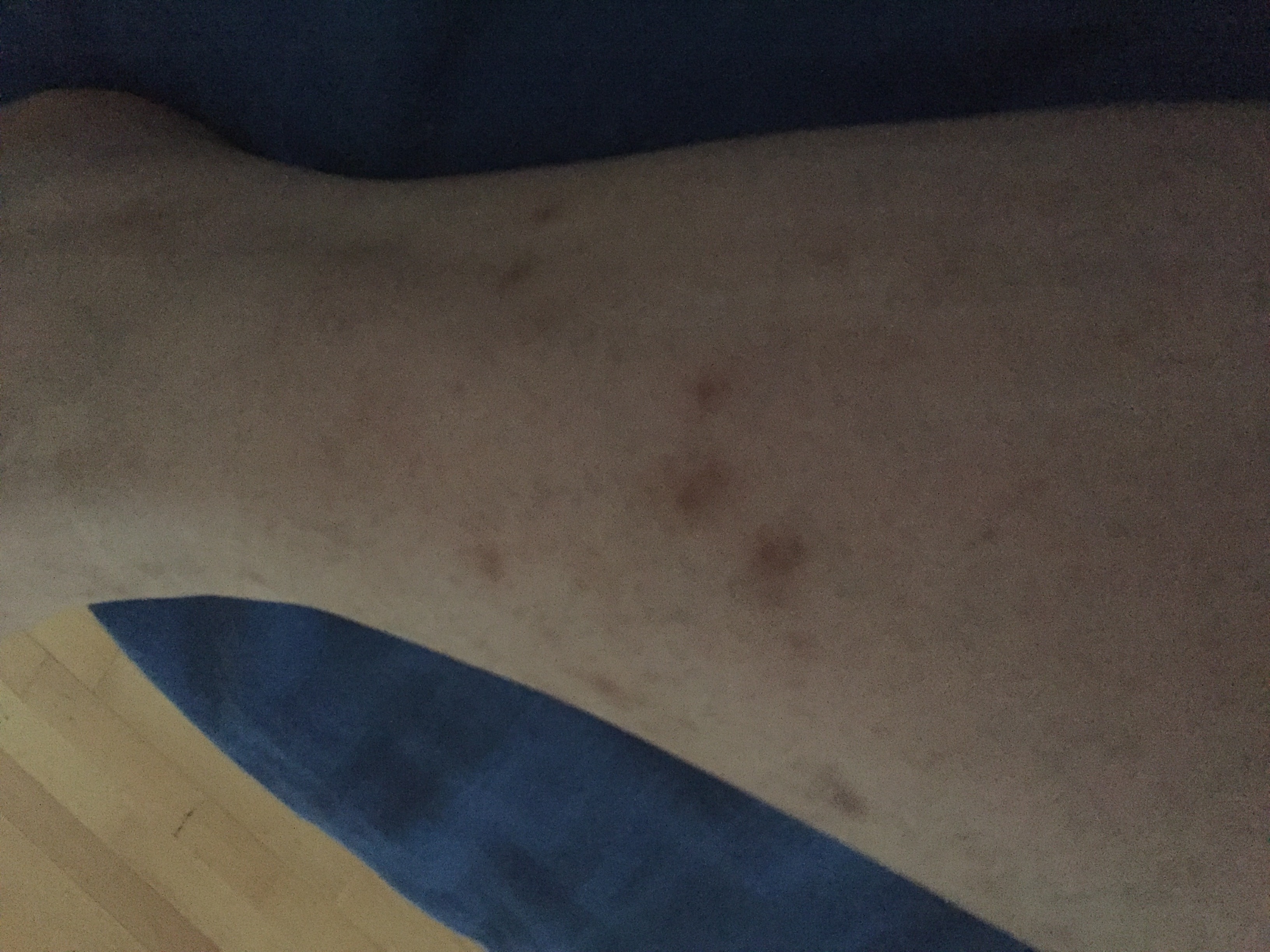 Dunkle Flecken von Mückenstichen? (Gesundheit, Haut, Mückenstiche)