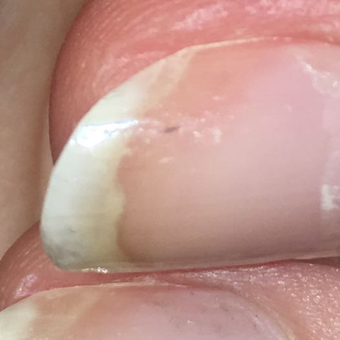 Dunkle Streifen Auf Mehreren Fingernageln Gesundheit Frauen Krankheit Dunkle Streifen Auf Mehreren Fingernageln Gesundheit Frauen Krankheit