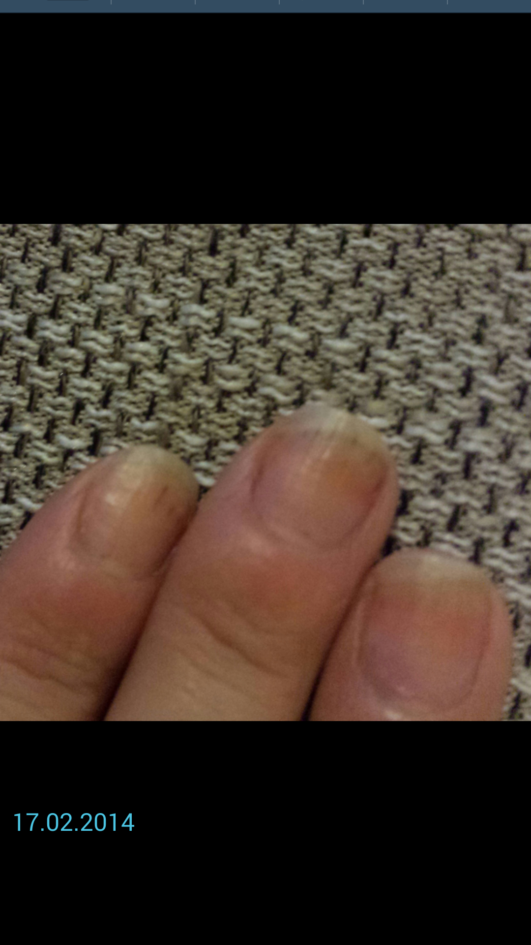 Dunkle Streifen unterm Nagel.. Hilfeeeee :( (Nägel, Verfärbung)