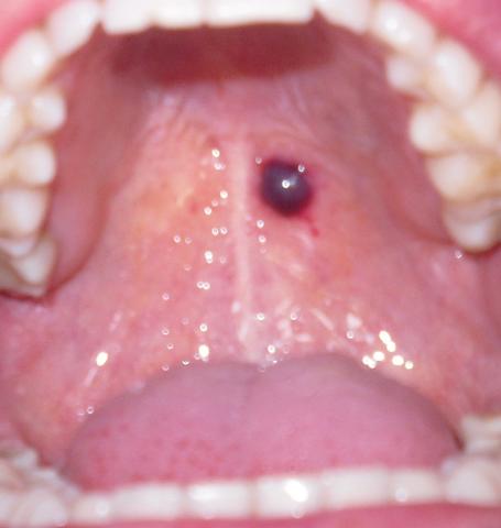 Wunde im Mund - (Gesundheit, Medizin, Arzt)