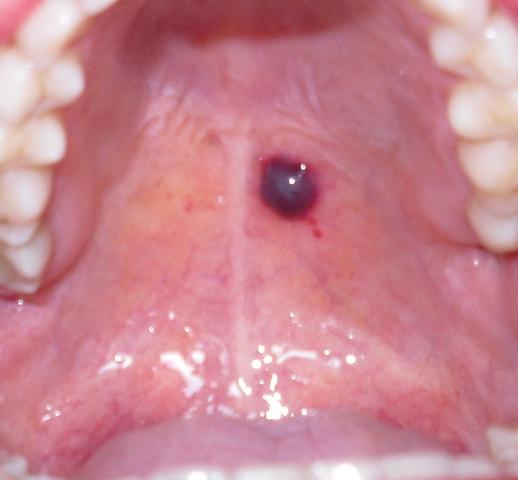 Dunkle Wunde in Mundhöhle (Gesundheit, Medizin, Arzt)