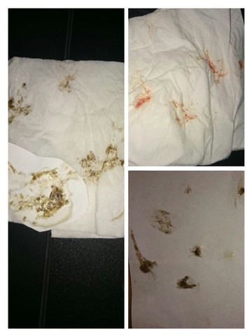 Dunkler Auswurf Blut Im Sputum Obwohl Das Lungen Rontgen Ohne Auffalligen Befund War Hat Jemand Erfahrungen Rauchen Lunge Copd Dunkler Auswurf Blut Im Sputum Obwohl Das Lungen Rontgen Ohne Auffalligen Befund War Hat Jemand Erfahrungen Rauchen Lunge Copd