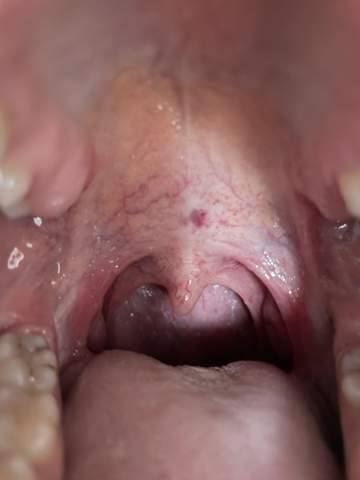 Dunkler Fleck Am Gaumen Und Leichte Halsschmerzen Gesundheit Und Medizin Hals Mund Dunkler Fleck Am Gaumen Und Leichte Halsschmerzen Gesundheit Und Medizin Hals Mund