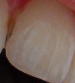 Zahn - (Zähne, Zahnarzt, Zahnmedizin)