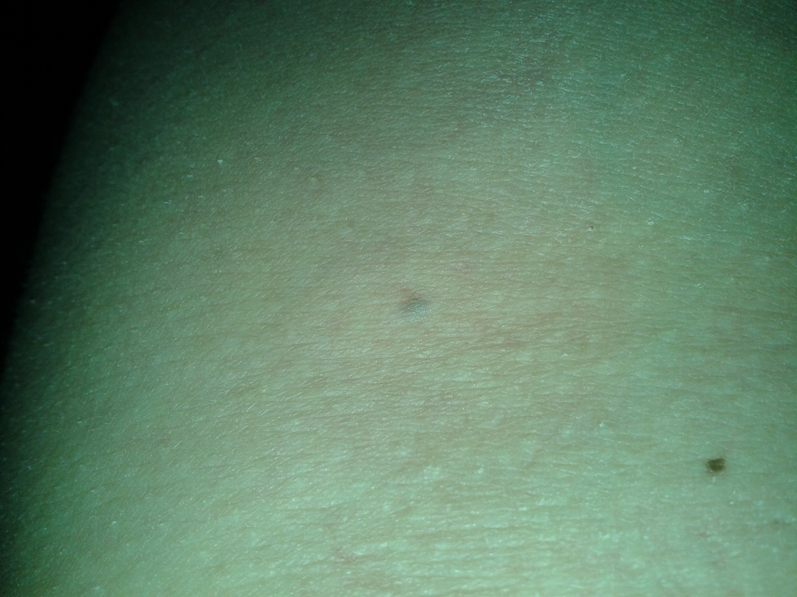 dunkler Fleck unter der Haut (Gesundheit, Medizin, Flecken)