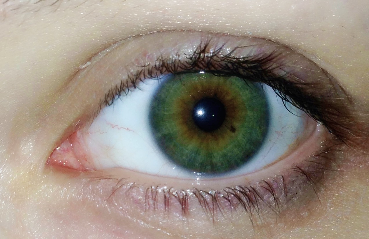 Dunkler Punkt im Auge (was ist das?) /Bild (Augen, Punkte) Dunkler Punkt im Auge (was ist das?) /Bild (Augen, Punkte)