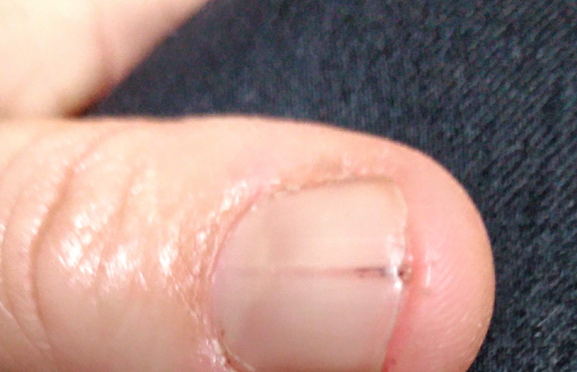 Dunkler Strich Daumennagel? (Gesundheit und Medizin, Haut, Fingernägel)