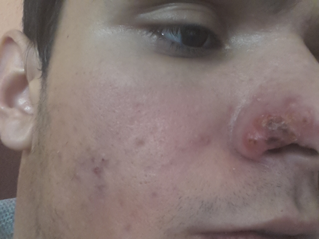 durch erkältung etwas an der nase bekommen hilfe