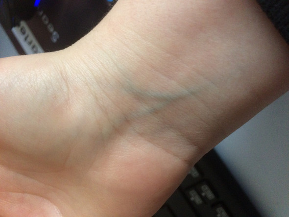 Durchblutungsstorungen In Ader An Hand Hypochonder Durchblutungsstorungen In Ader An Hand Hypochonder