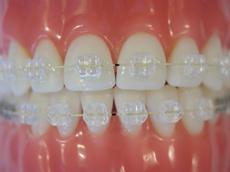 Durchsichtige Zanhspange - (Zähne, Zahnspange, durchsichtig)